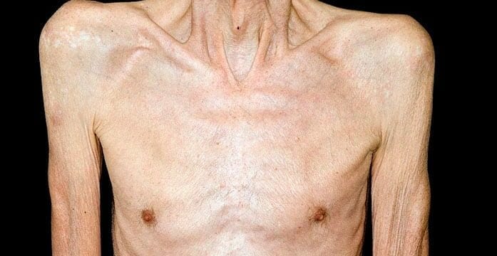 cachexia, cancer Muscle wasting syndrome cause of many cancer-related deaths